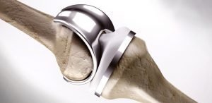 Best joint replacement surgeon in Kolkata