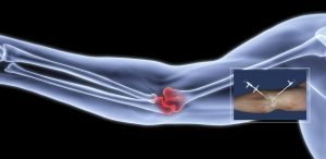elbow arthroscopy