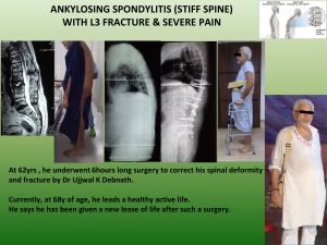 Ankylosing Spondylitis surgeon in kolkata