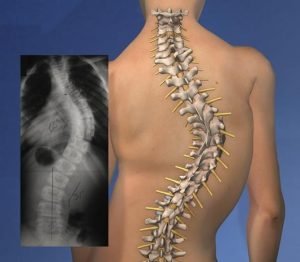 Scoliosis Correction