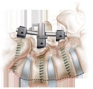 Spinal operations