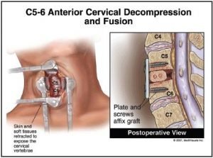 Cervical Spinal Surgery