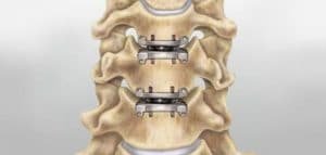 Cervical Spinal Surgery