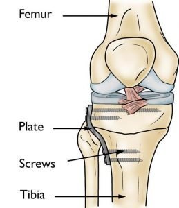 Knee Surgeries