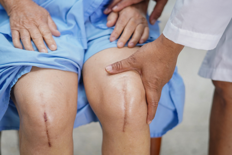 Healed scars after bilateral total knee replacement being checked by a doctor