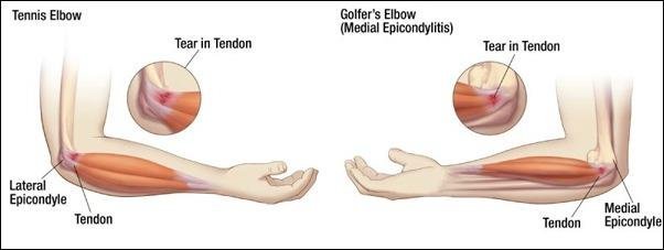 Elbow Pain