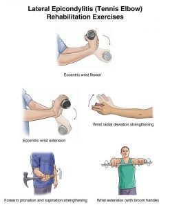 Elbow Pain-Tennis Elbow Exercises