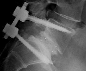 BMP in Spine Surgery