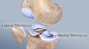 meniscal injury