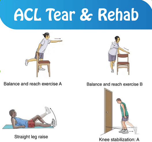ACL Tear & Rehab