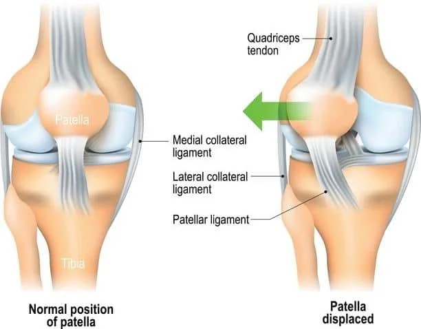 Normal position of the patella compared with a displaced (dislocated) patella