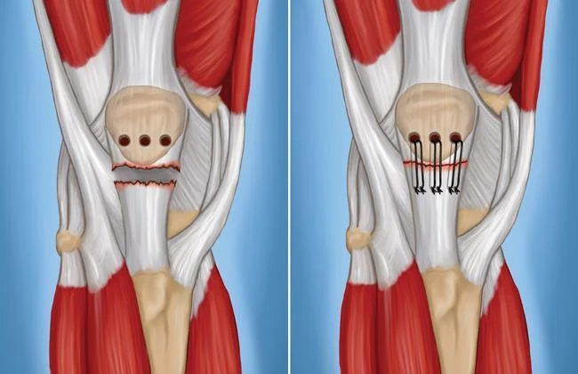 Torn patellar tendon before and after surgical repair with sutures through the kneecap